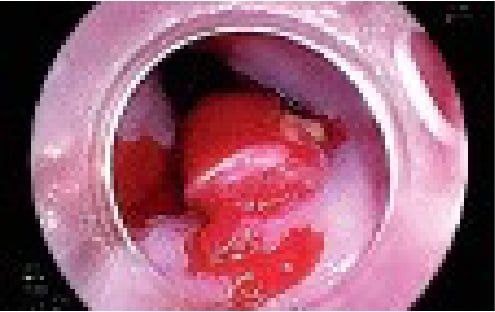Fig. 1: Barrett’s intramucosal cancer
