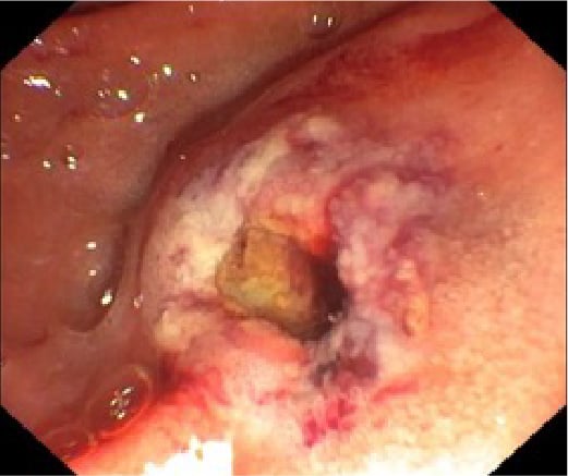 Fig. 2: Unremarkable resection site after endoscopic papillectomy