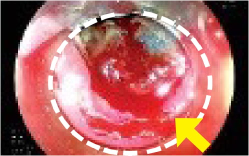 Fig. 2: Bleeding during ESD. Yellow arrow indicates bleeding point; White dot circle indicates resected area