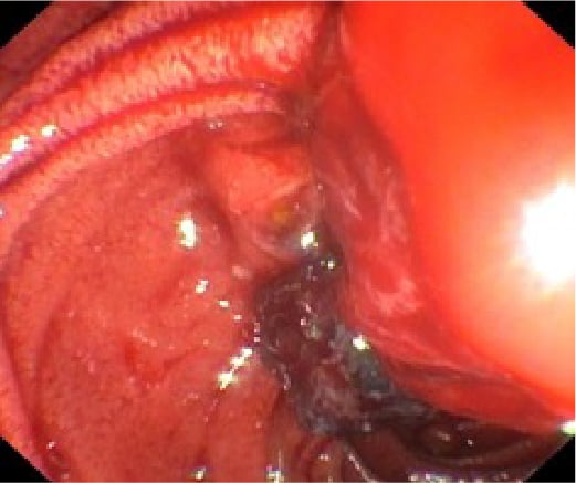 Fig. 3: Severe arterial bleeding on the following day