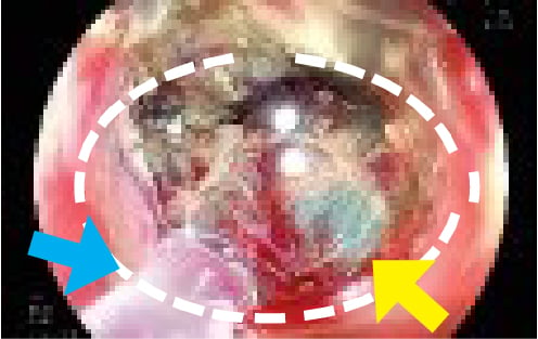 Fig. 3: White dot circle: transparent PuraStat covered the bleeding site: Yellow arrow: bleeding point; Blue arrow: tip of the catheter