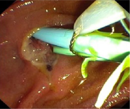 Fig. 6 : Clear bleeding site two days later. Endoprotheses (pancreatic and bile duct) could be removed