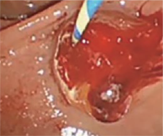 Fig.1 Confirmation of bleeding from Sphincterotomy site