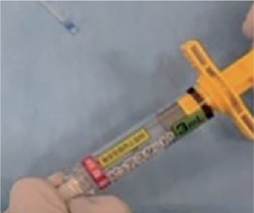 Fig.2 Filling the catheter with PuraStat